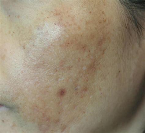 黑斑|黑斑 (Melasma)